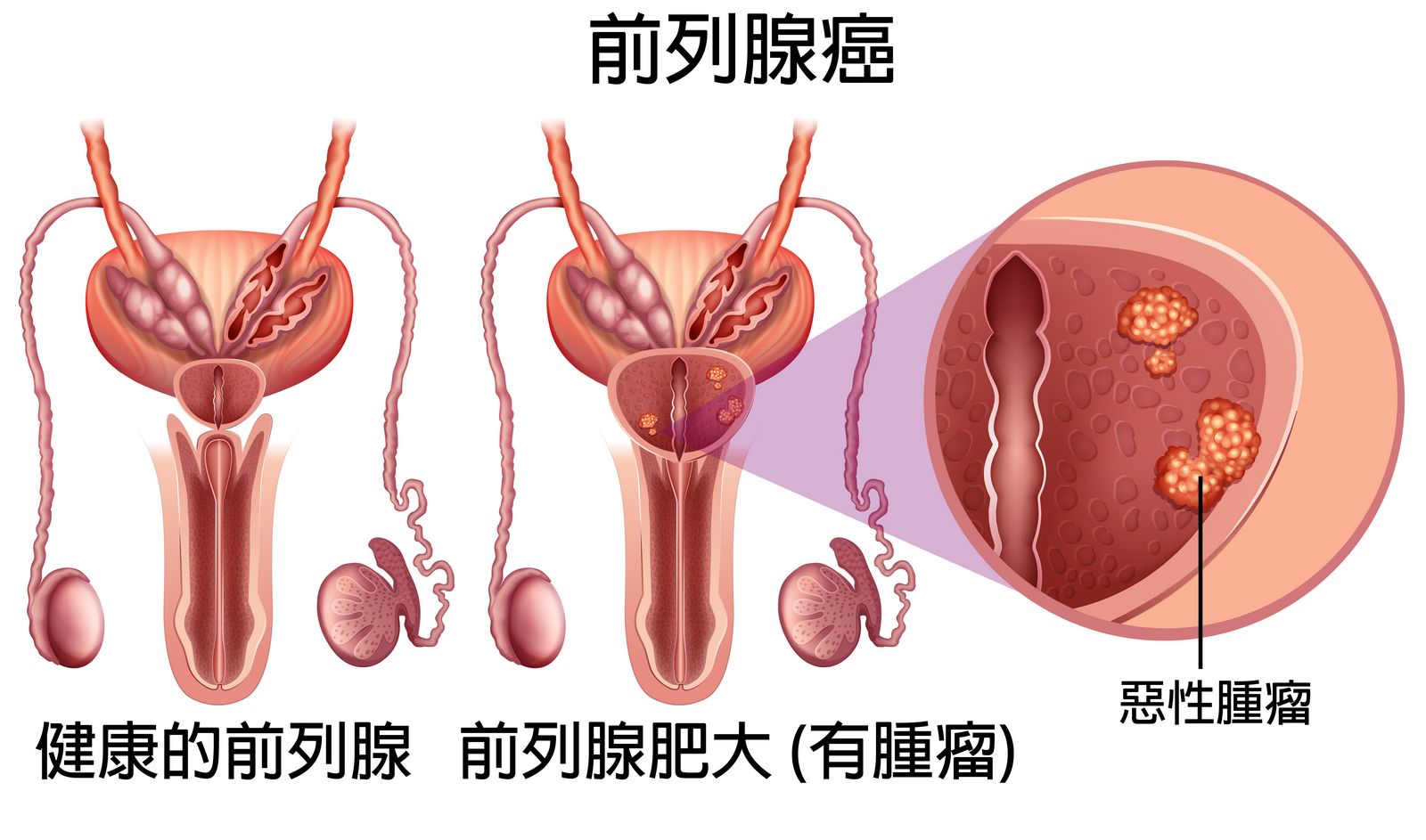 痛 排尿